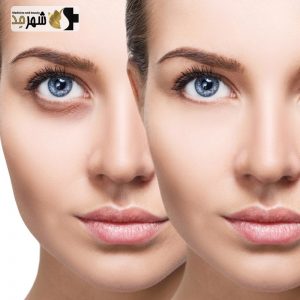 فیلر (ژل) رووفیل مدل فاین
