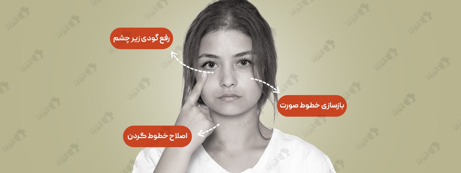 فیلر (ژل) 2 سی سی سوئیسی آلیاکسین مدل اس آر