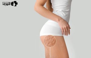 روش‌های خانگی از بین بردن سلولیت بدن کدام است؟